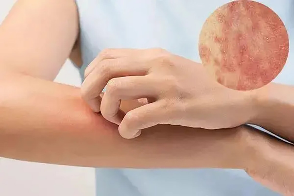 肝功能异常，或会出现“2痒，3黑”如果你有请尽早检查。